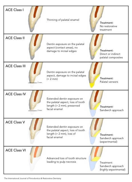 ACE classification