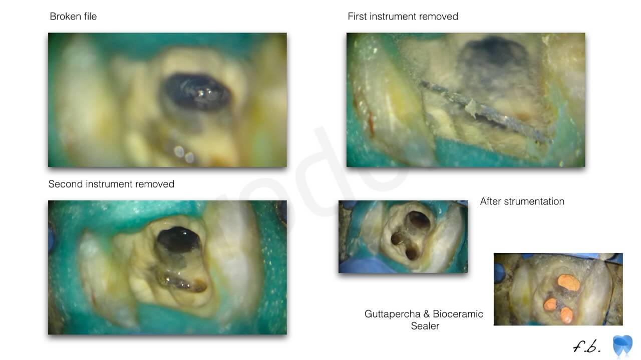 broken file, endodontics