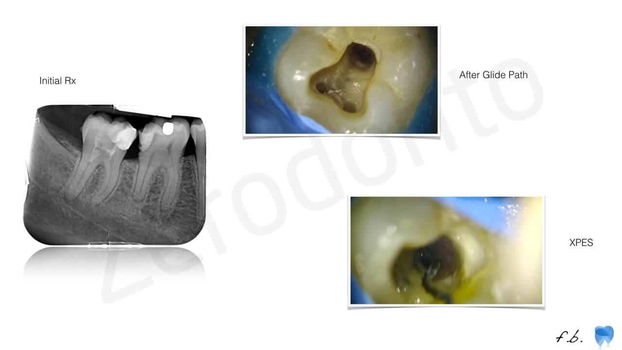 root canal shaping, zerodonto, bellucci