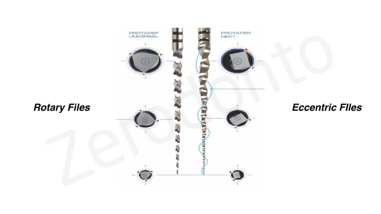 Root canal shaping with latest generation expanding instruments