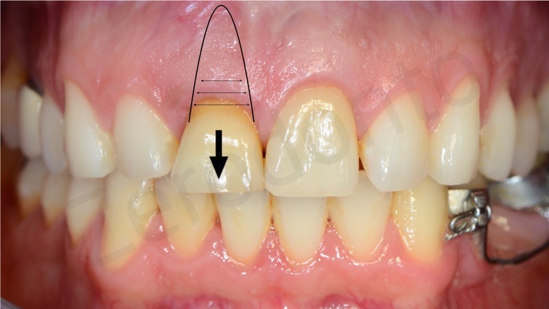 slow orthodontic extrusion