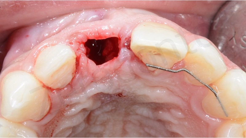 socket preservation