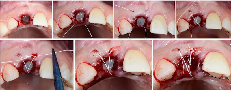 double stabilization suture