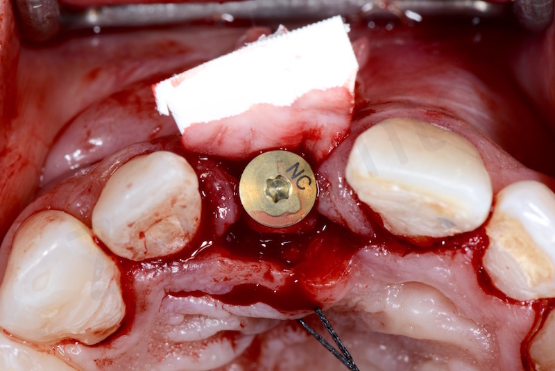 collagen membrane