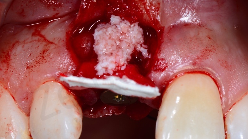 bone graft