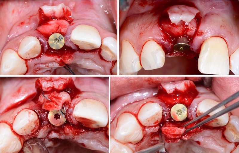 soft tissue management