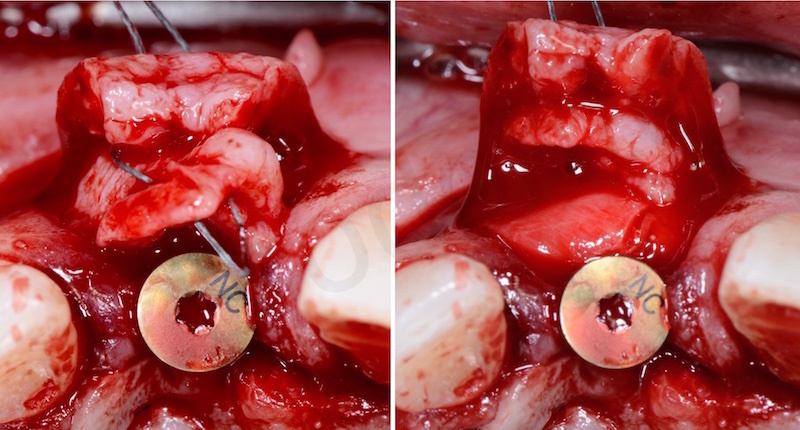 gingival flap