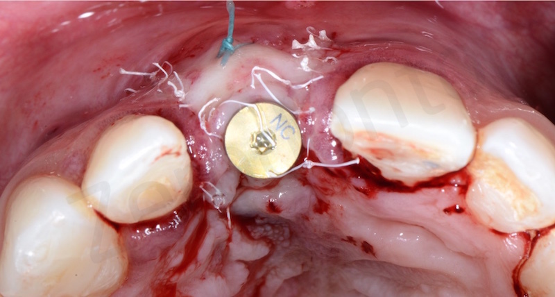 suturing