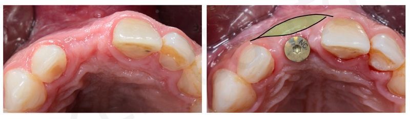 biotype thickening