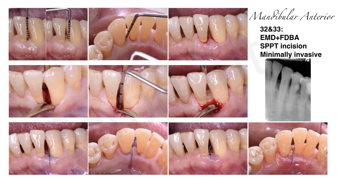 Comprehensive management of severe periodontitis