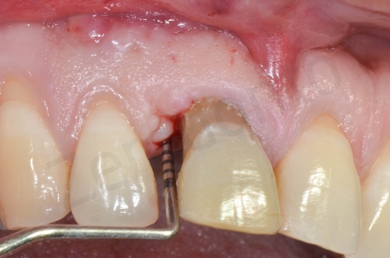 periodontal probing