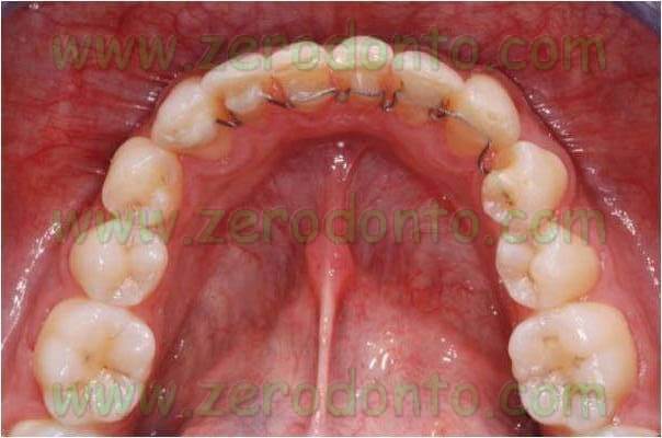 ortodonzia linguale controlli successivi