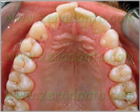 soprapposizione dei denti anteriori