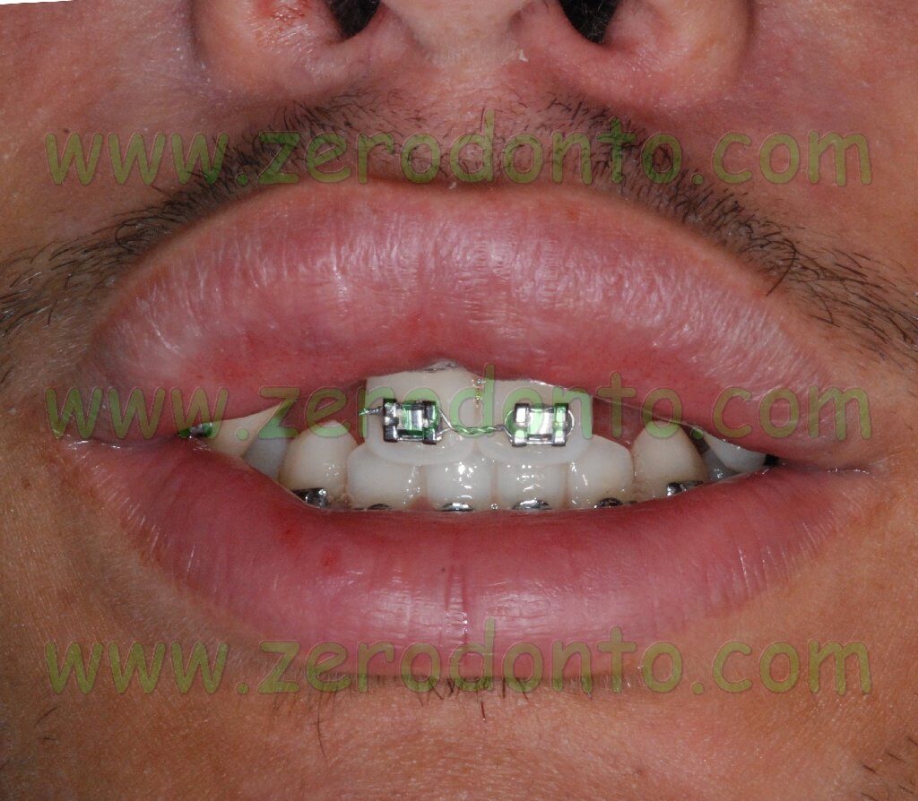 Estetica periorale agenesia dentaria