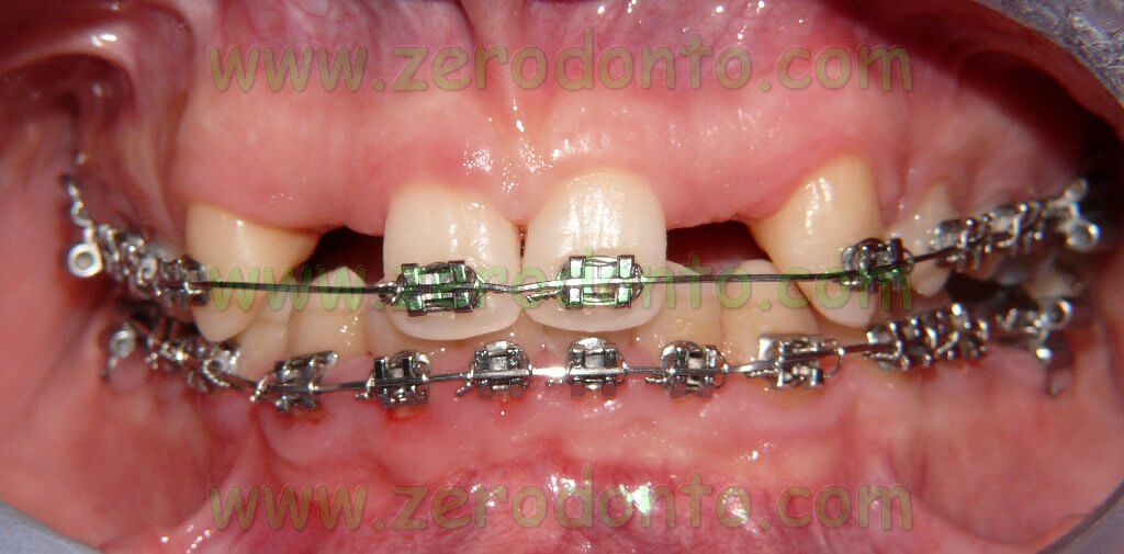 Trattamento ortodontico pre-implantare