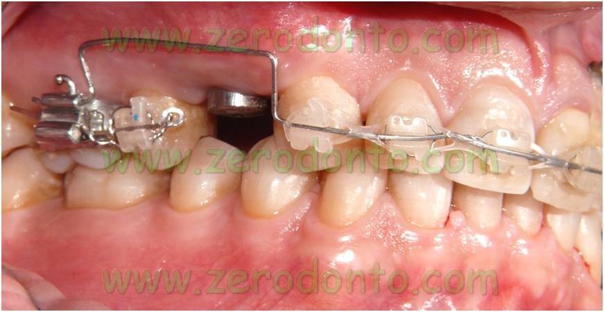 Leva ortodonzia