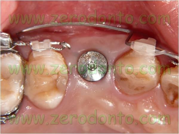 Impianto ortodontico