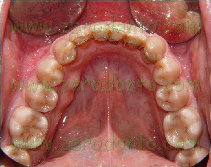 Retainer ortodontico
