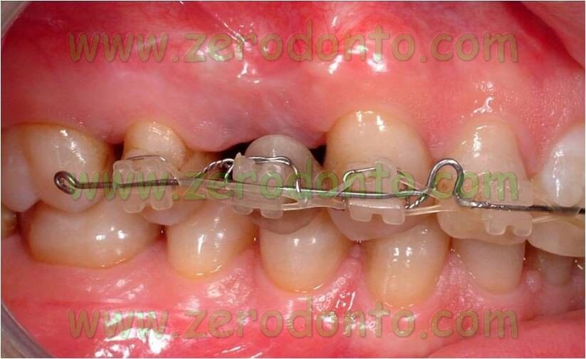 Impianto ortodonzia
