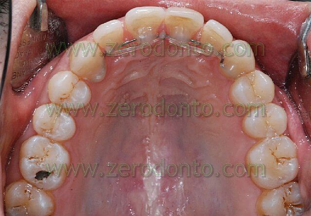 ortodonzia invisibile per i denti anteriori
