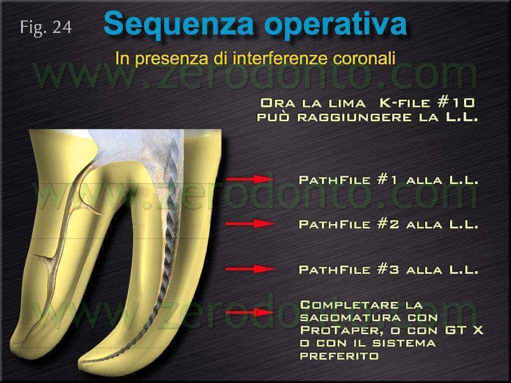 interferenza coronale endodonzia
