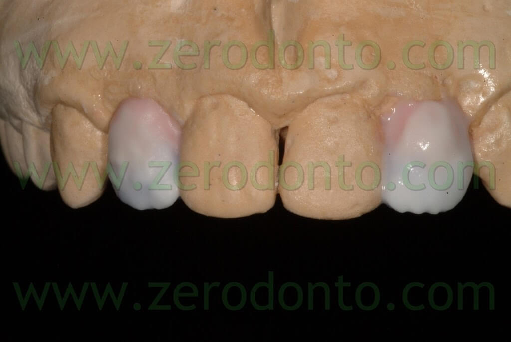 stratificazione porcellana dentale