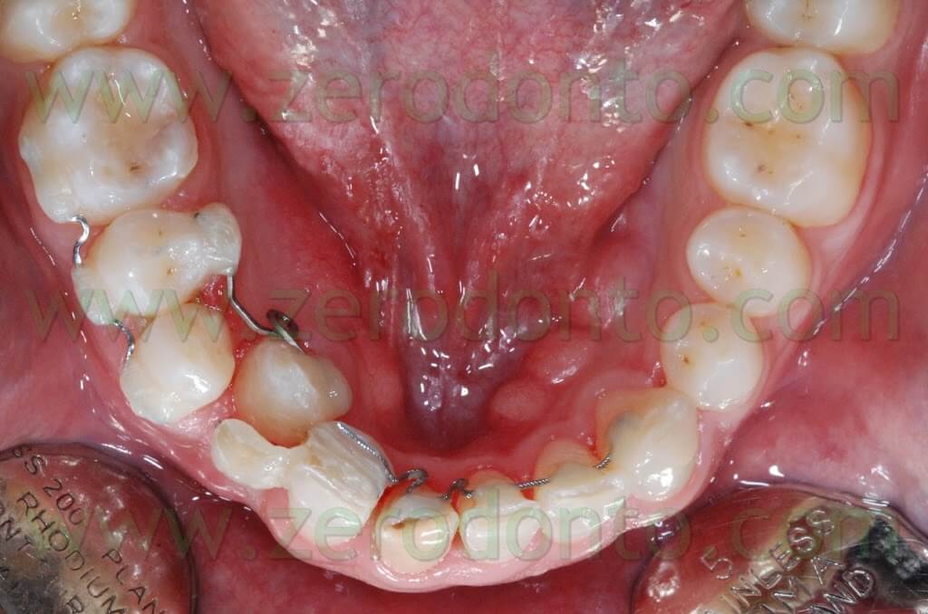 terapia ortodontica invisibile