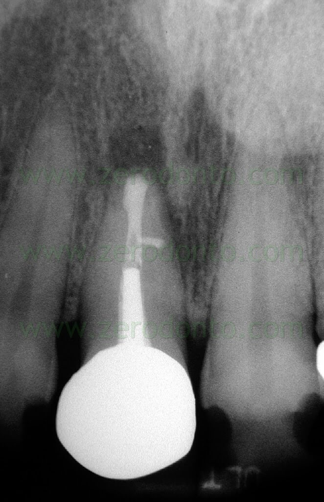 endodonzia chirurgica