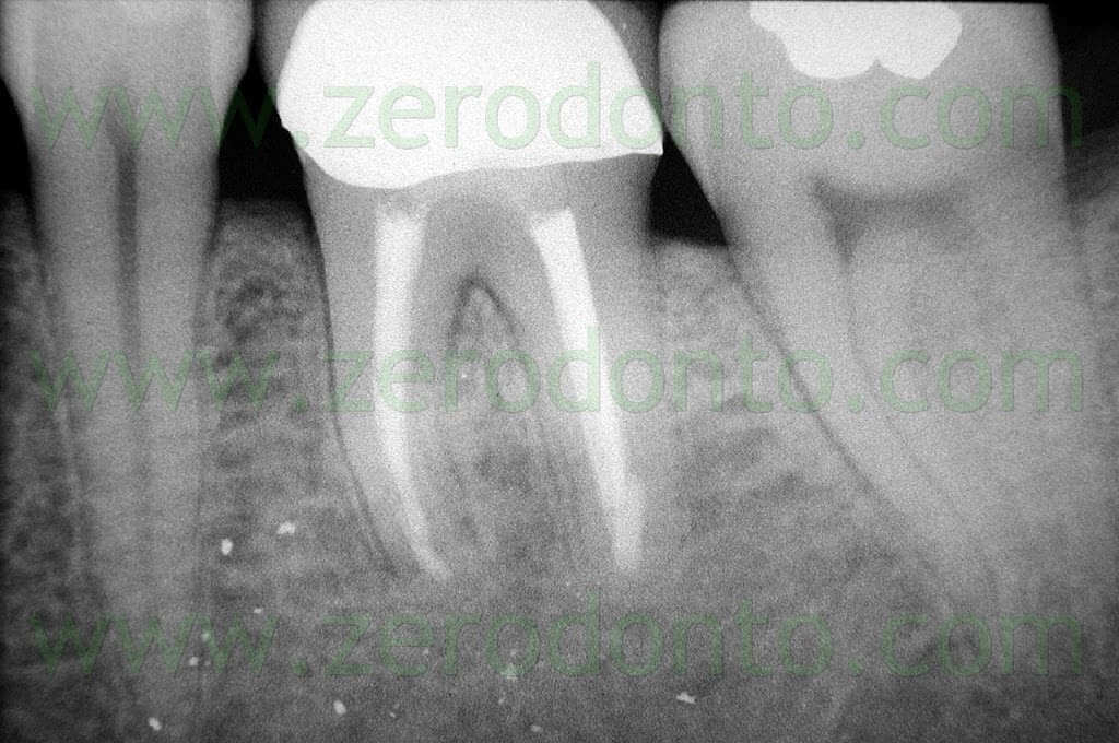 terapia endodontica