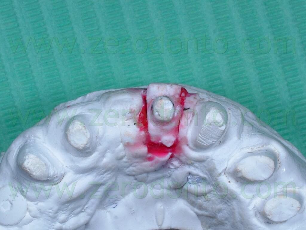 ortodonzia tipo invisalign con provvisorio