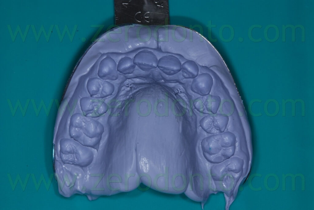 11 impronta dentale