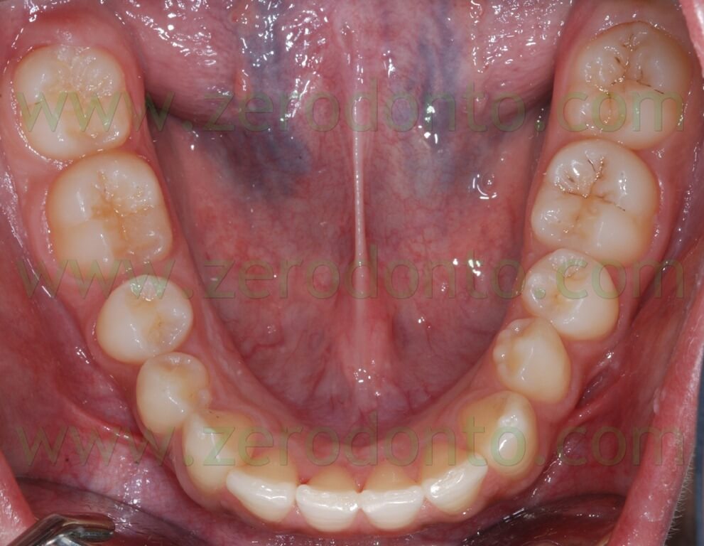 6 occlusale inferiore seconda classe molare e canina jpg