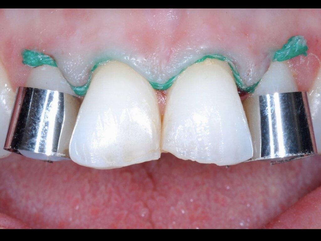 54 matrici protezione preparazione denti