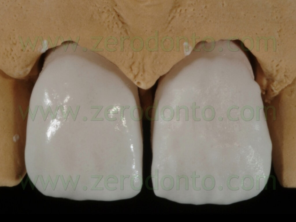90 stratificazione ceramica massa dentina faccette