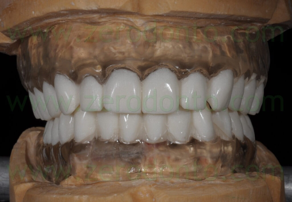 - (48) denti in bario