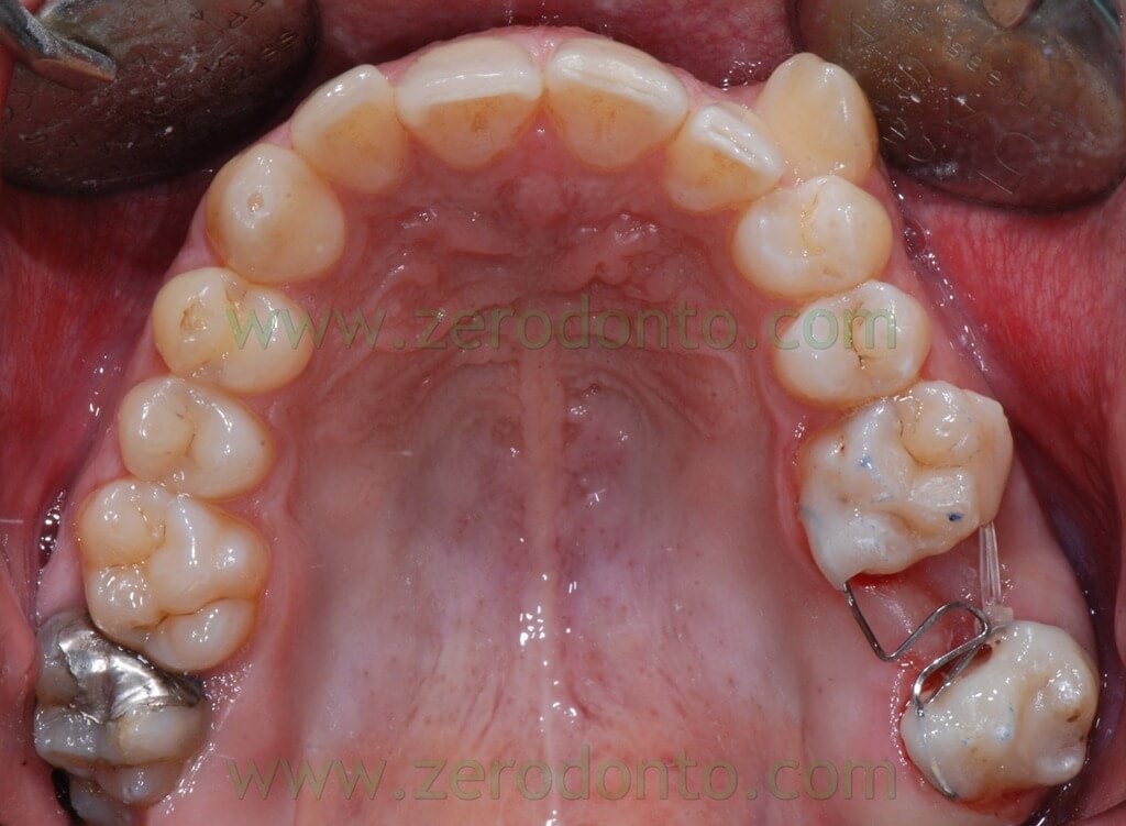 14 chiusura spazi denti