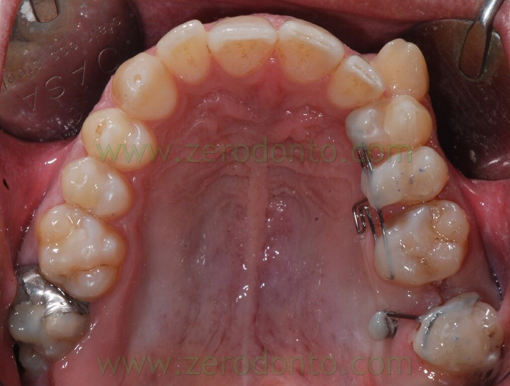 18 miniscrews ortodonzia