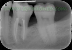 “Hopeless tooth” treatment 10