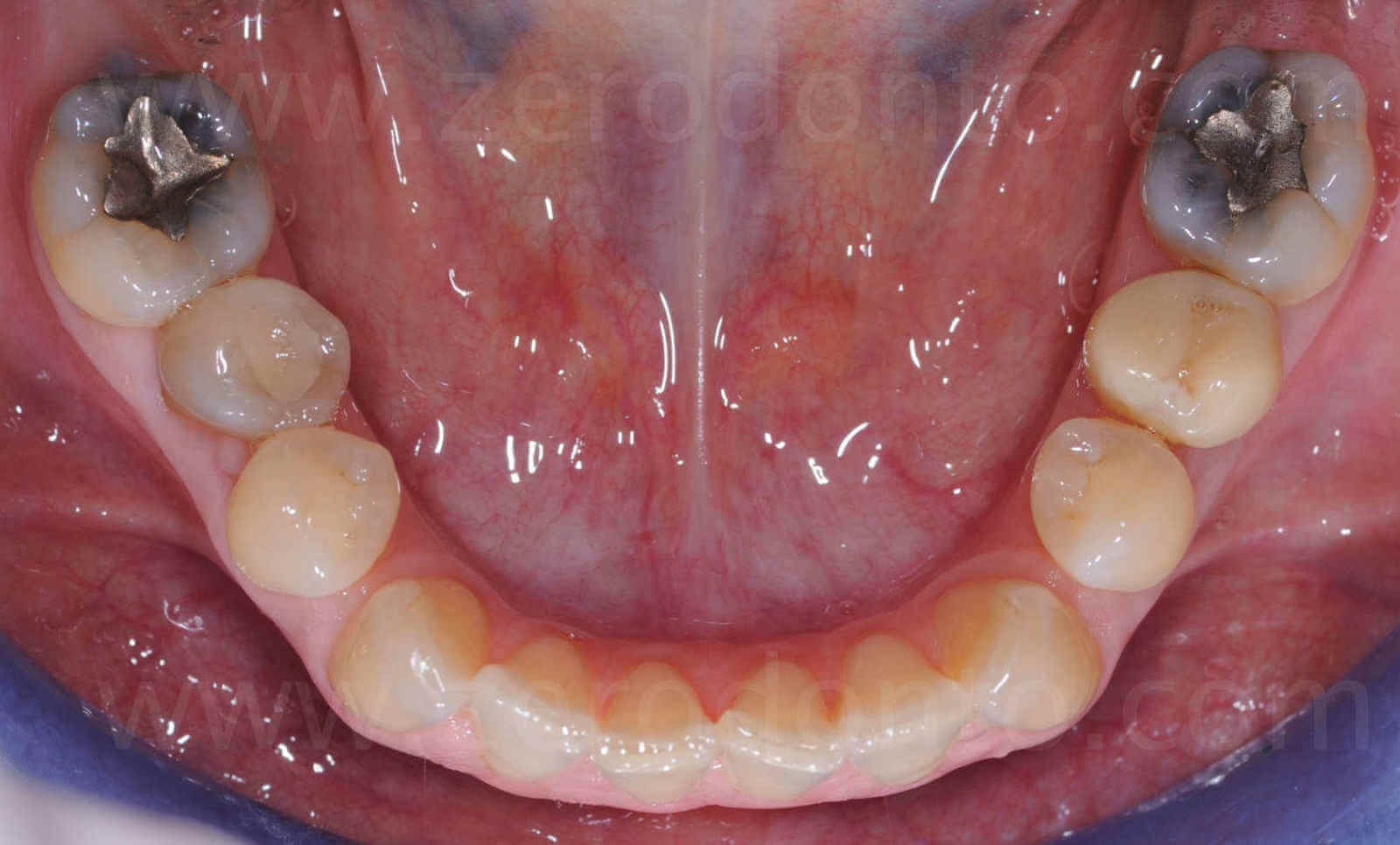 vista linguale erosione dentaria