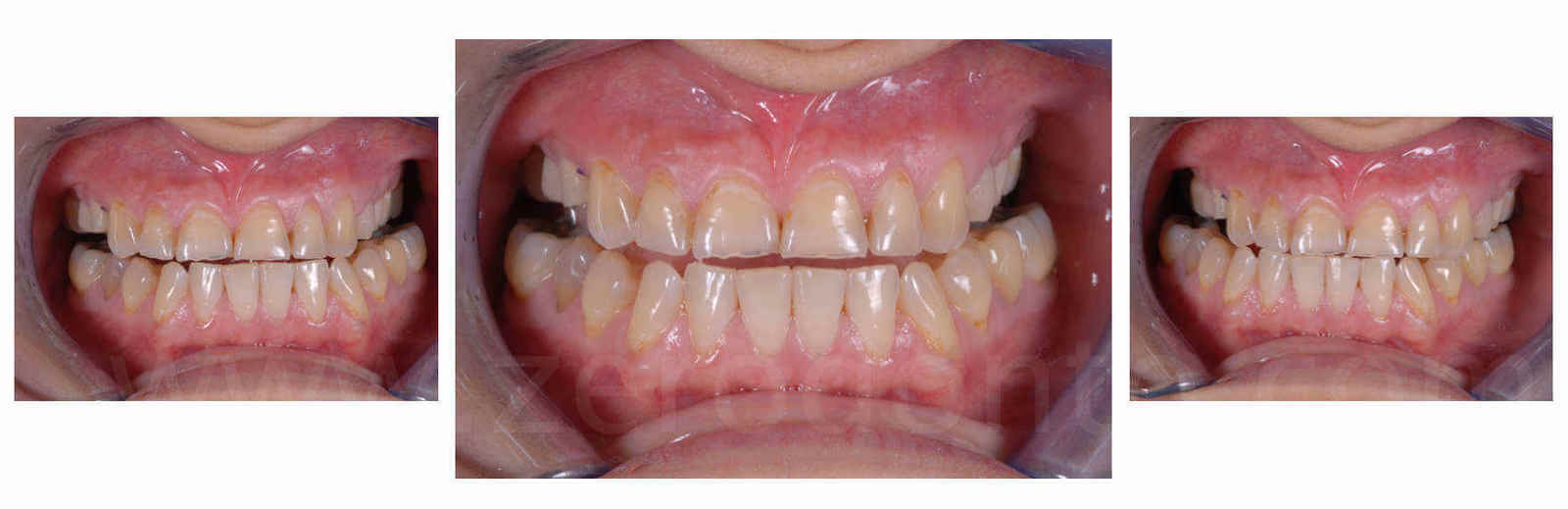 assenza della guida incisale in paziente con erosione dentale mauro fradeani zerodonto