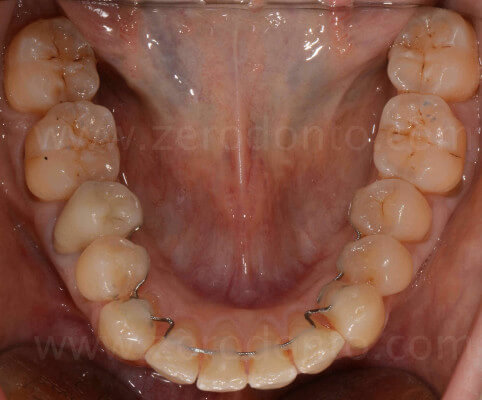 ortodonzia invisibile mariniello