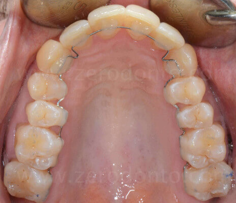 ortodonzia invisibile mariniello