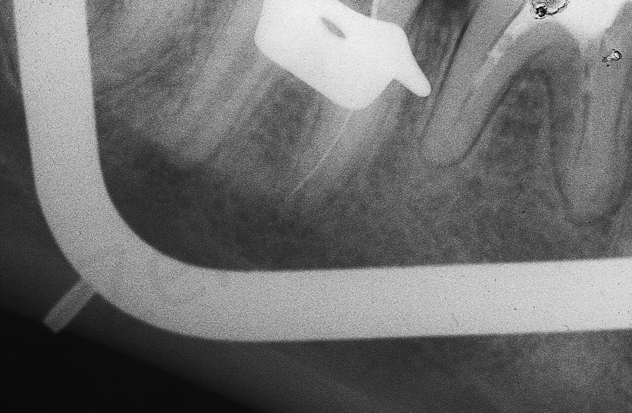 Fig. 22. C. Il telaio metallico interferisce con il radiografico, tanto da proiettare la sua ombra sulla radiografia