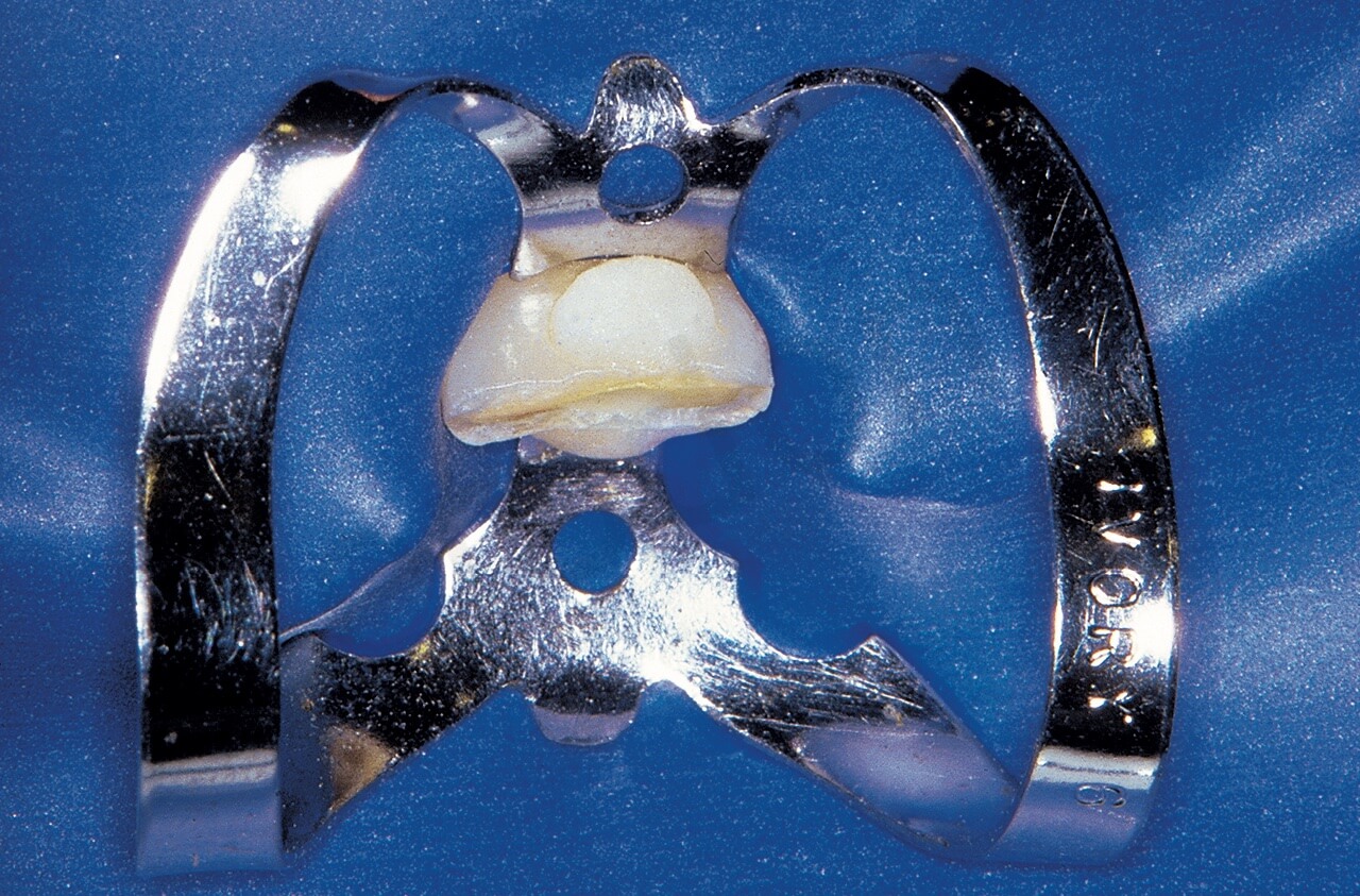 Fig. 32. A. Il dente fratturato che richiede la terapia endodontica non era ancora erotto completamente ed aveva l’equatore ancora al di sotto del bordo gengivale. Per poter posizionare l’uncino della diga è stato necessario polimerizzare due palline di composito sullo smalto vestibolare e palatino
