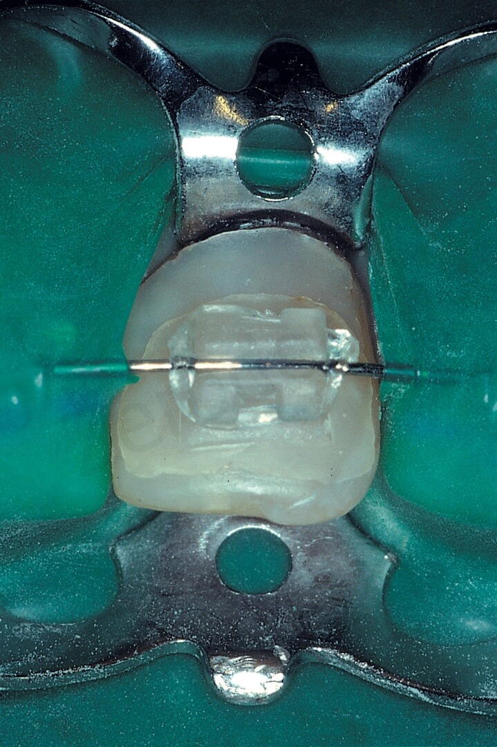 Fig. 38. A. Il filo ortodontico impedisce al foglio di gomma una chiusura ermetica. 