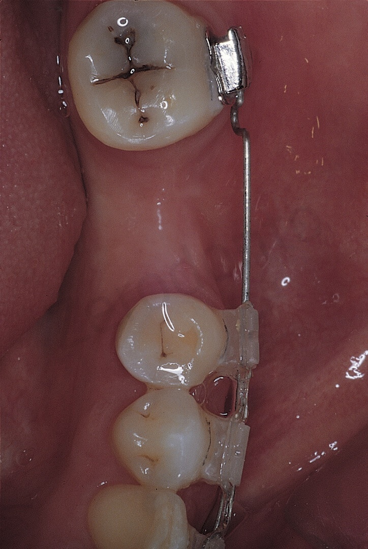 Il secondo premolare sinistro necessita di terapia endodontica. A. Visione occlusale