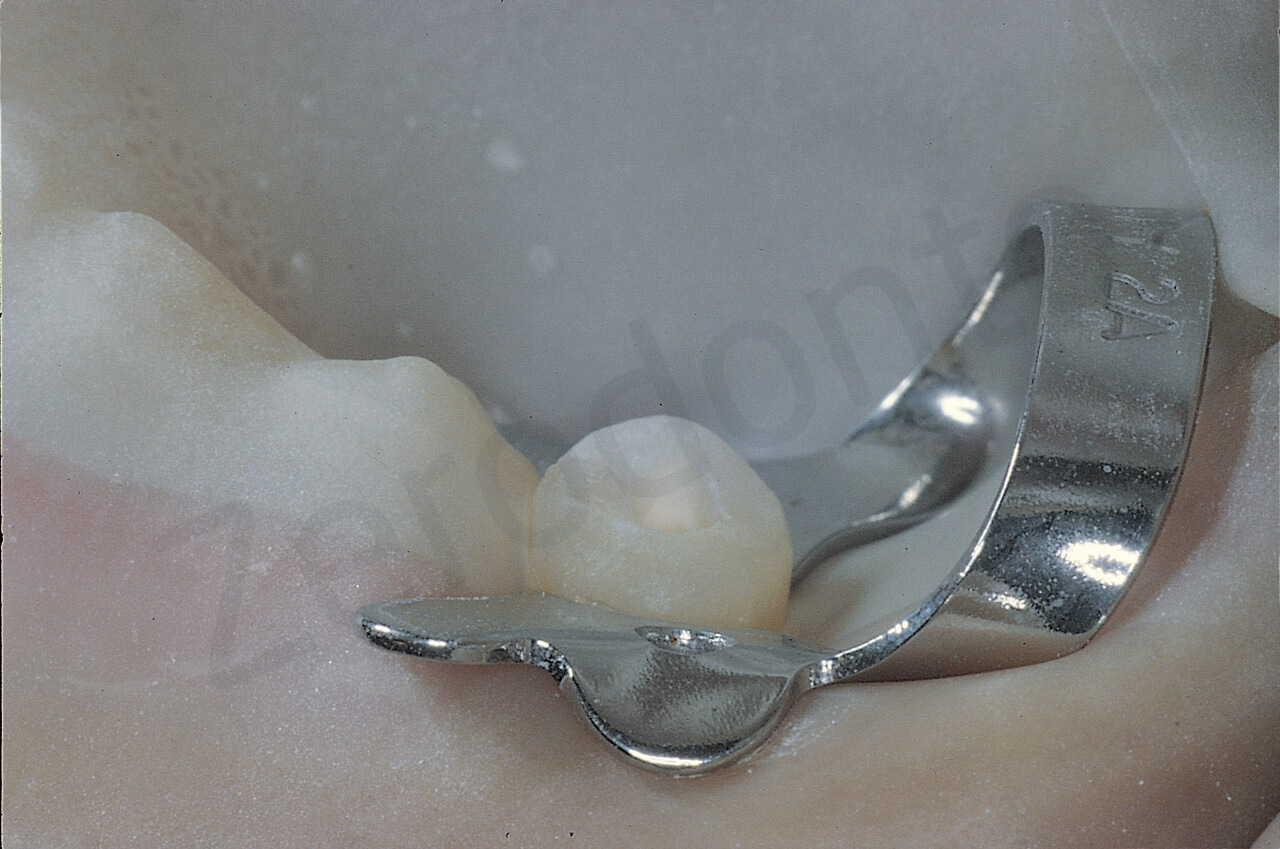 E. L’uncino è stato posizionato al di sopra dell’attacco ortodontico e del filo e pertanto la diga chiude perfettamente.