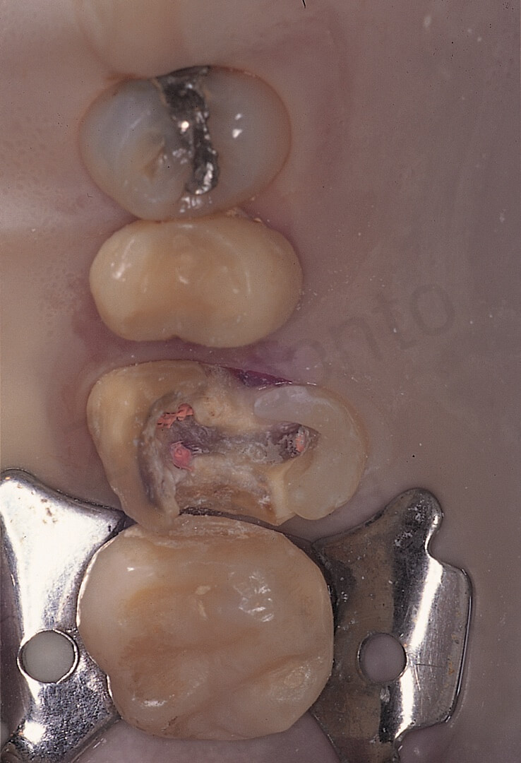 Lo stesso tipo di pre-trattamento è stato eseguito al molare superiore, per consentire un posizionamento stabile dell’uncino della diga.
