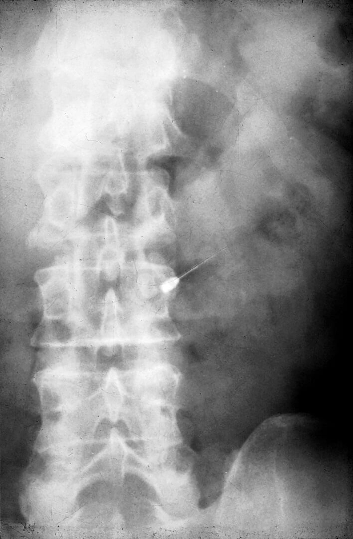 L’esame radiografico mostra la presenza di uno strumento endodontico nelle anse intestinali di un paziente che poche settimane dopo è deceduto.44