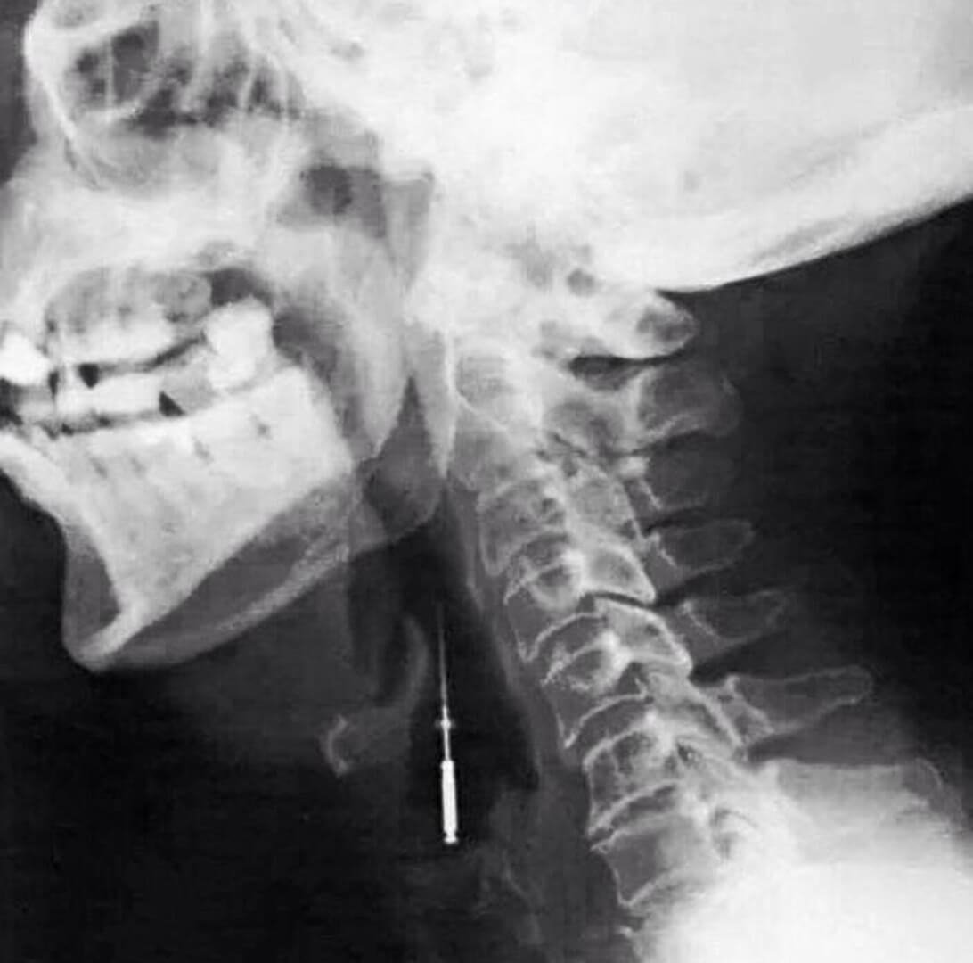 Fig. 6. L’esame radiografico mostra la presenza di uno strumento endodontico nelle prime vie respiratorie di un paziente che poche settimane dopo è deceduto.